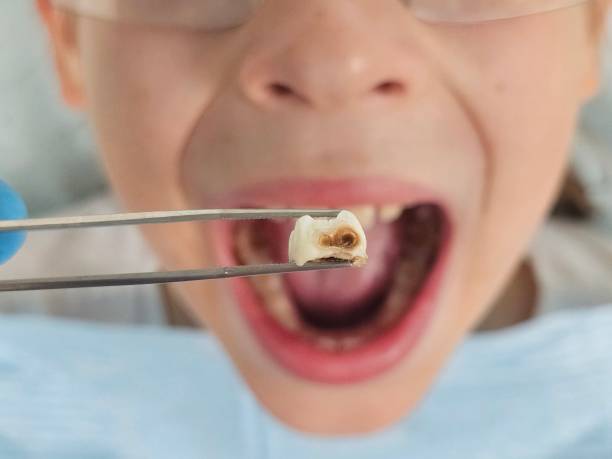 Best Emergency Root Canal Treatment in Kingston, PA
